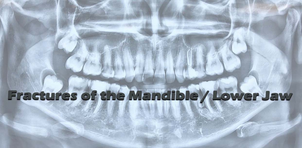 Fractures of the Mandible / Lower Jaw